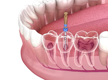root canal12